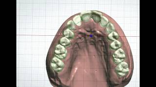 Lab Procedure for digital bracket indirect bonding [upl. by Betteann]