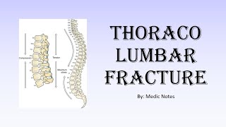 Thoracolumbar fracture  AO classification clinical feature investigation treatment [upl. by Heath875]