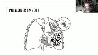 PULMONER EMBOLİ  DR DAHİLİYE EĞİTİM PLATFORMU ÖRNEK DERS Eski [upl. by Eneladgam194]