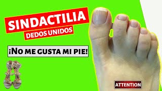 👍SINDACTILIA Dedos unidos ¡No me gusta mi Pie [upl. by Hultin]