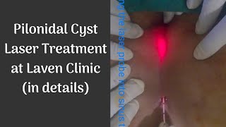 New Laser Treatment of Pilonidal Cyst using local anesthesia at Laven Clinic Group in details [upl. by Etep900]