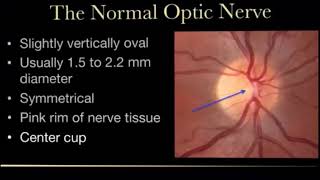 Glaucomatous Optic Disc Changes  DrSaad Alshamrani [upl. by Refinne]