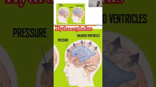 Hydrocephalus nursingcompetition hydrocephalus [upl. by Gnik]