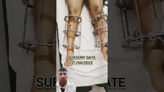 🌡️🧪Limb surgery orthopaedic physiotherapy fashion legs feet lowerlimb mbbs medicalanimation [upl. by Aseiram]