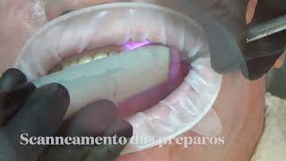 Provisorio sobre dente [upl. by Nylessej]