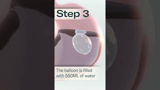 Allurion Gastric Balloon  A Simple Solution to Lasting Weight Loss [upl. by Pooi]