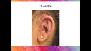 Microtia Ear Surgery  The Healing Process with the Porous Implant Ear Reconstruction technique [upl. by Apps]