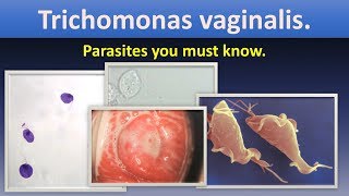 Trichomonas vaginalisLife cycle Lab diagnosis Infection TransmissionTrichomonasvaginalisMLS [upl. by Ennaeerb]