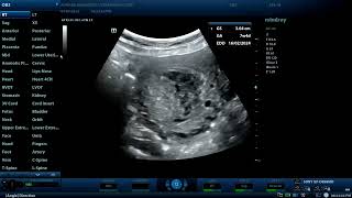 Partial hydatidiform mole Diagnostic ultrasound cases [upl. by Zebada954]