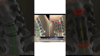 MobiC Artificial Disc Replacement Cervical Spine Surgery [upl. by Elyk98]