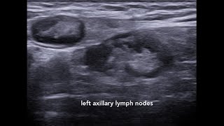 Axillary Lymphadenopathy Ultrasound Case 1 [upl. by Sherrer]