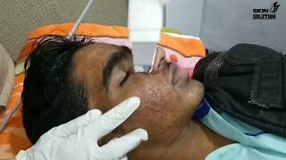 what is a hydrafacial treatment dermabrasion face deep cleaning [upl. by Anyel353]