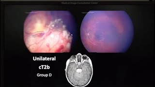 Retinoblastoma Pathology  Dr Brenda Gallie [upl. by Badger]