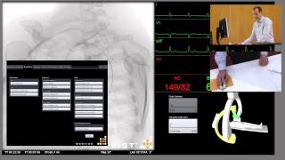 Aortic Arch Angiogram [upl. by Culliton681]