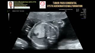 Congenital Cystic Adenomatoid Malformation of the Lungs [upl. by Arykat]