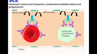 Systemic Lupus erythematosus SLE 2016 [upl. by Leotie]