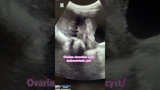 Chocolate cyst  Ovarian endometrioma ultrasound video ovariancysts chocolate ultraradiology [upl. by Barncard]