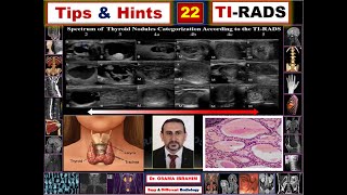 Tips amp Hints 22 TI RADS how to score thyroid nodule [upl. by Liris]