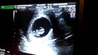 BABY HEARTBEAT  8 WEEKS 3 DAYS PREGNANT [upl. by Fania]