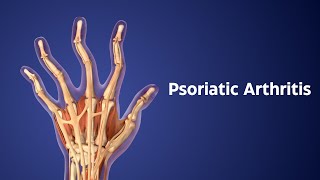 Title Understanding Psoriatic Arthritis Symptoms Treatment and Early Signs [upl. by Darrill326]