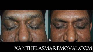 Xanthelasma removal at home without scarring the most time saving and cost effective solution [upl. by Enneyehs]