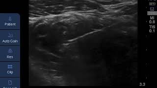 Proximal approach for ultrasoundguided infraclavicular brachial plexus block [upl. by Nessah]