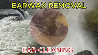 Ear Wax Removal 186 Earwax is very dry and very hard causing itching and pain  Ear Cleaning ASMR [upl. by Eyaj]