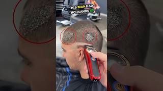 🐌Thousands of scalp psoriasis eggs on his head🥨🤯 shorts [upl. by Okomom]