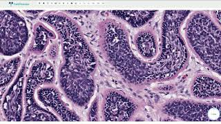 Cylindroma  Histopathology [upl. by Otrebcire259]