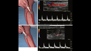 Upper Limb Arterial Doppler  How to do د عمرو صلاح [upl. by Edik190]