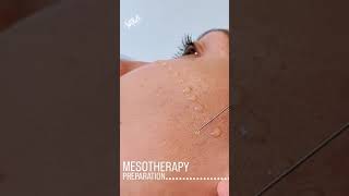 Mesotherapy Facial Treatment Benefits Procedure amp FAQ  EDEN AESTHETICS Dubai [upl. by Schear]