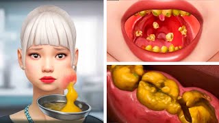 ASMR Dental Cleaning Procedures amp Tonsil Stones Removal Acne on the face  Deep Cleaning Animation [upl. by Tengler]