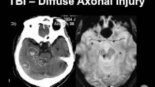 Diagnosing Brain Hemorrhages [upl. by Novert]