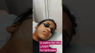 Qswitch NdYAG LASER for birthmark  NevusQswitch NdYAG treatment [upl. by Nosyarg]