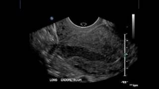 endometrium post lscs 1avi [upl. by Spain]