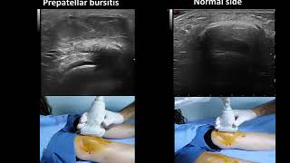 Ultrasound guided prepatellar bursitis injection Housemaids knee [upl. by Sera]