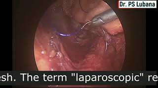 Laparoscopic Rectopexy Surgery  Dr PS Lubana Indore [upl. by Airetas911]