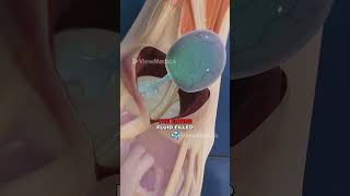 Ganglion Cyst Removal 3D Animation [upl. by Midian]