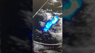 Case 35 echocardiography Modified left blalock taussig shunt in 5 days old neonate [upl. by Clovah]