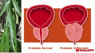 La mejor cura para la próstata en todo el mundo no hay nada mejor [upl. by Dianna]