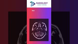 Medial Medullary Syndrome Dr Umamaheswara Reddy Dr Damayanthi Dr Chandana [upl. by Otis]