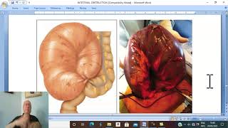 Intestinal disorders in Arabic 9  Volvulus  part 1   by Dr Wahdan [upl. by Calhoun]