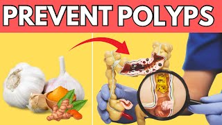 Top 9 Miracle Foods to Prevent Polyps and Colon Cancer [upl. by Yelssew490]