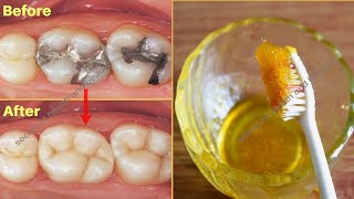 3 நாளில் பல் சொத்தை மறையும் அதிசயம்  cavities removal home remedies sutha pal  pal sothai [upl. by Eseenaj]