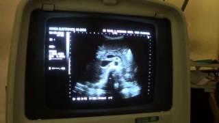 ASCITES ultrasound [upl. by Barraza]