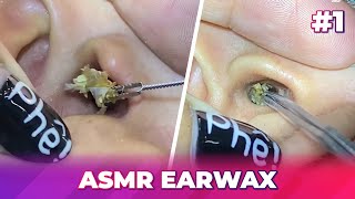 1 Earwax ASMR  Surprised by the dirty ear and how to clean it [upl. by Primo340]