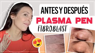 PLASMA PEN FIBROBLAST ANTES Y DESPUES  CarolinaSKB CarolinaTV plasmapen plasmafibroblast [upl. by Knighton]