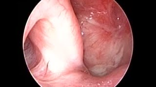 Nasopharyngeal Carcinoma SCC 10 years Follow up after Radiotherapy amp Chemotherapy [upl. by Akeinahs]