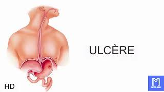 Ulcère causes signes et symptômes diagnostic et traitement [upl. by Octavia]