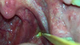 Tonsil Stone Removal By Yourself [upl. by Copeland650]